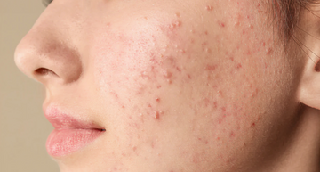 Produtos Coreanos para Acne