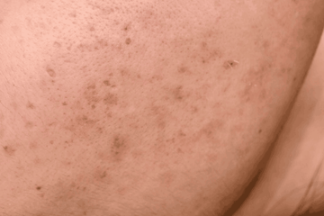 Manchas na Pele: Como Prevenir, Tratar e os Melhores Ingredientes Glowthie Glowthie Portugal