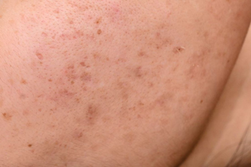 Manchas na Pele: Como Prevenir, Tratar e os Melhores Ingredientes