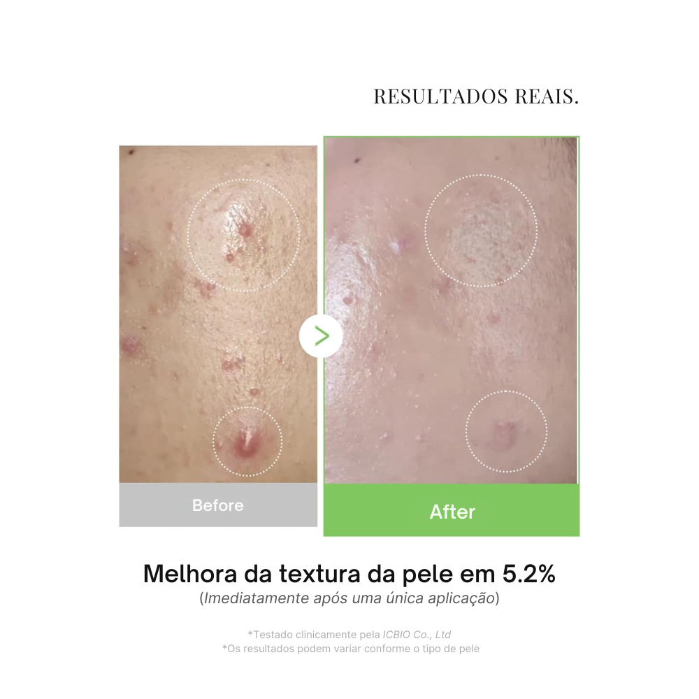 Uso diário da ampola Exosome Cica Tea Tree para pele suave e equilibrada. Disponível na Glowthie – loja de cosmética coreana em Portugal