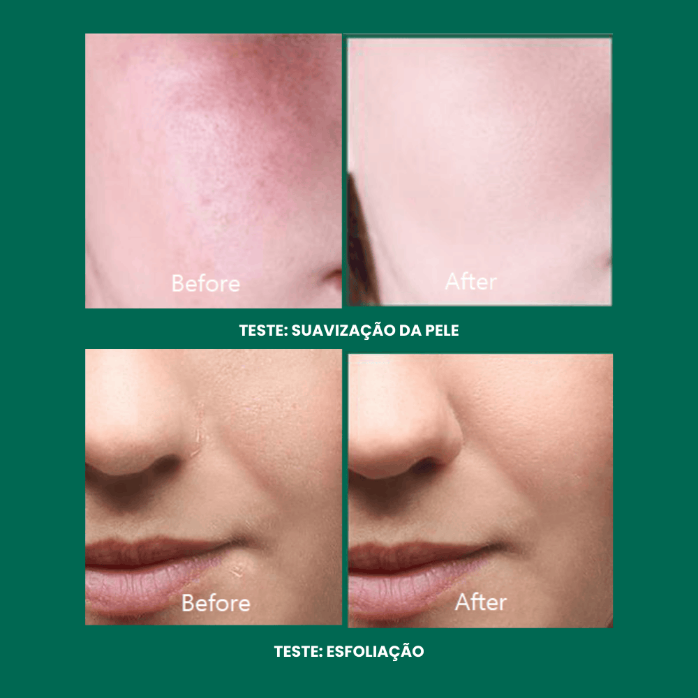Comparação de pele antes e depois de testes de suavização e esfoliação com cosméticos coreanos