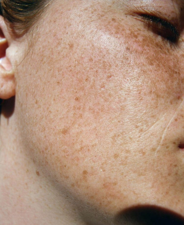 MANCHAS E HIPERPIGMENTAÇÃO